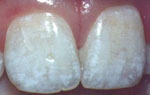Dental Fluorosis photos - 15356 Bytes