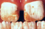 Dental fluorosis photos