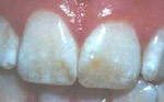 Dental Fluorosis photos